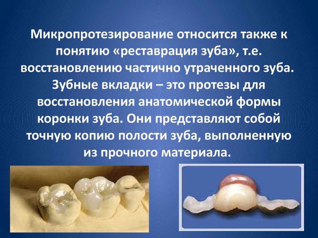 Препарирование зубов для их протезирования | врач-стоматолог мартынов дмитрий викторович