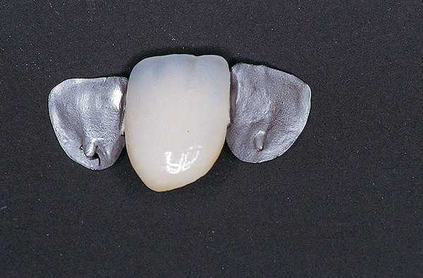 Протезирование зубов на 4 имплантах – отзывы, типы несъемных протезов