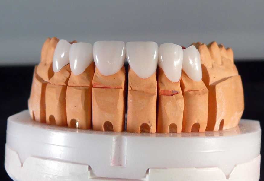 Протезирование зубов: показания, подготовка и порядок процедуры