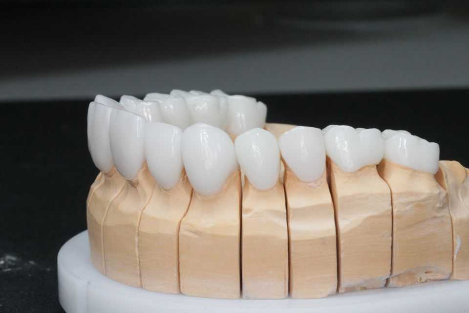 Протезирование зубов. виды зубных протезов: их различия и преимущества