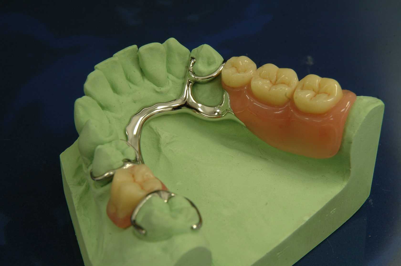 Препарирование зубов для их протезирования | врач-стоматолог мартынов дмитрий викторович