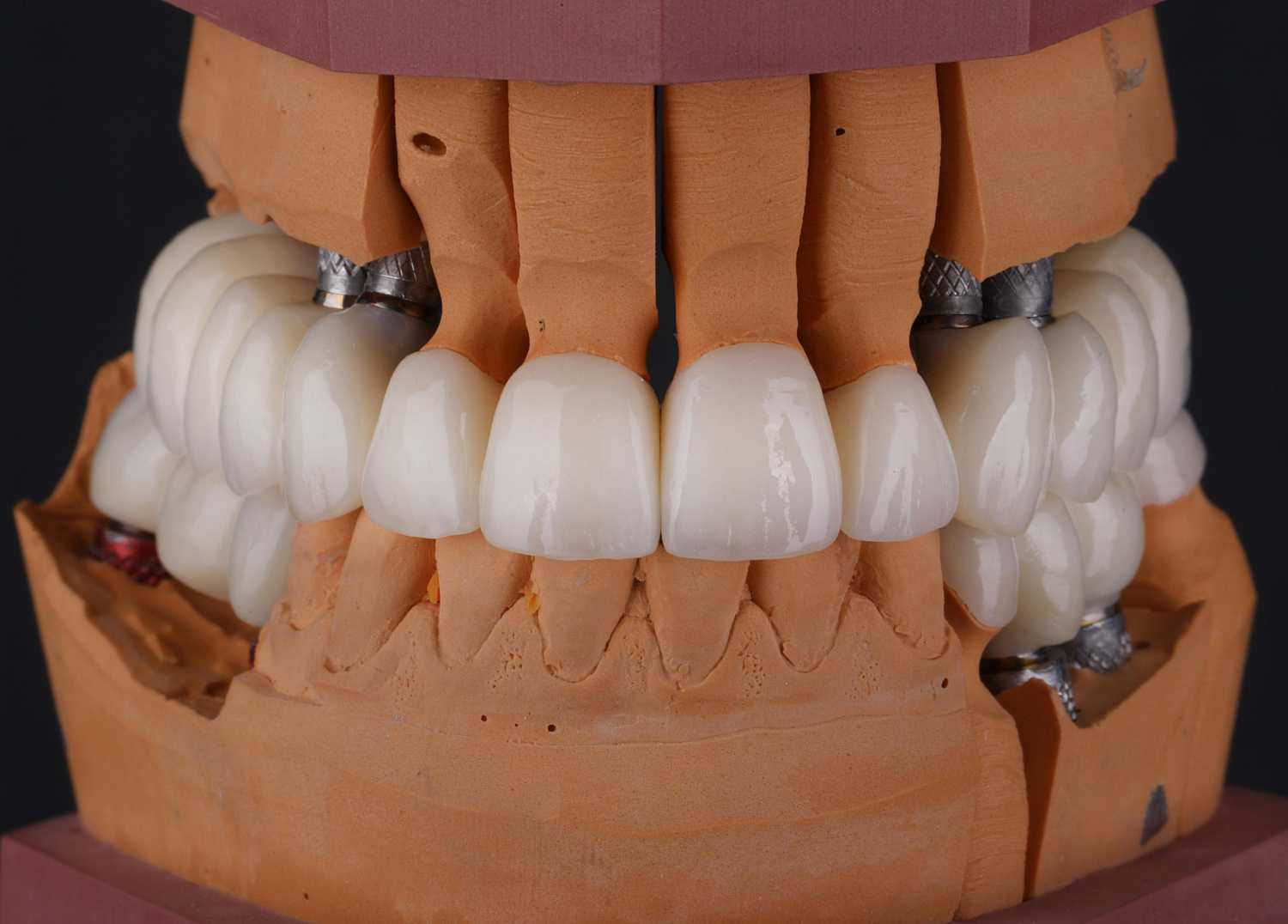 Новые технологии протезирования зубов | сеть стоматологических клиник зуб.ру