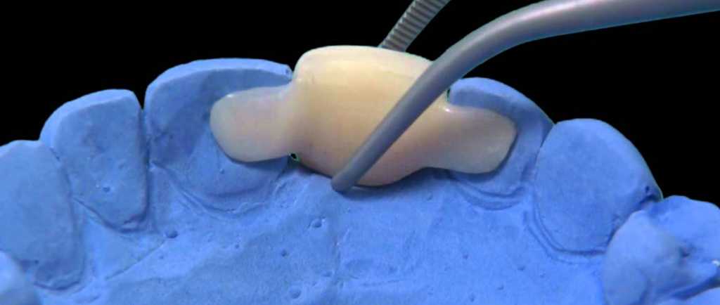 Протезирование зубов на 4 имплантах – отзывы, типы несъемных протезов