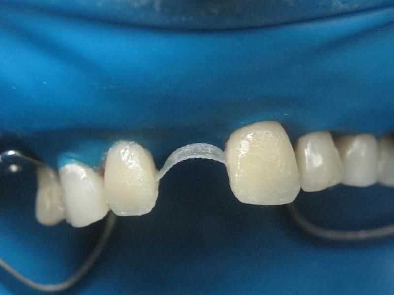 Виды зубных протезов: съемные и несъемные, срок службы, стоимость, отзывы