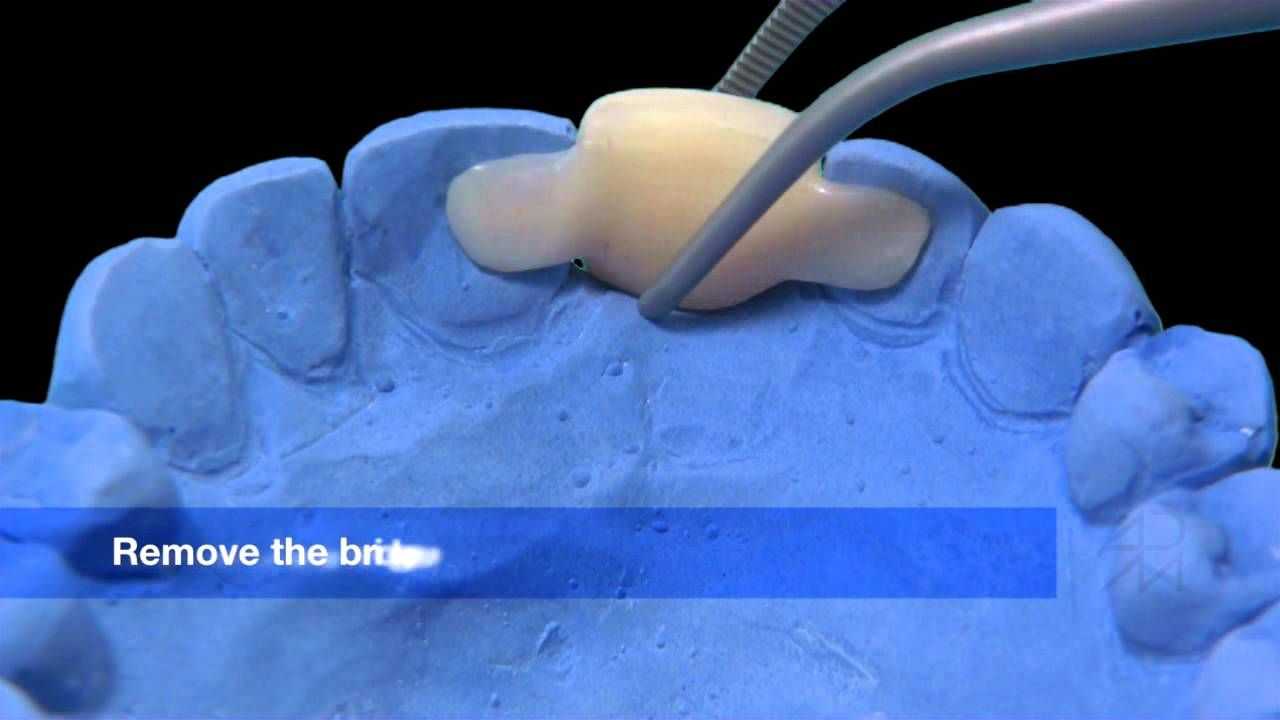 Современные методы протезирования зубов - виды и сравнение